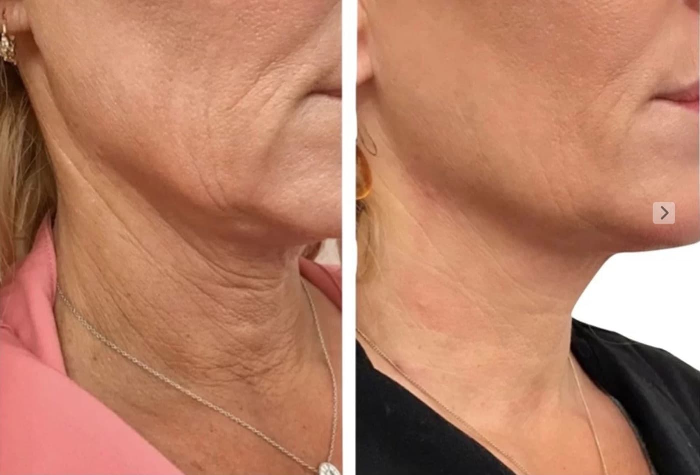 Resultado real de bioestimuladores de colágeno, antes e depois (1 de 2)