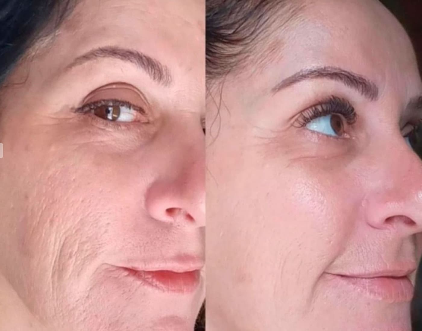 Resultado real de bioestimuladores de colágeno, antes e depois (2)