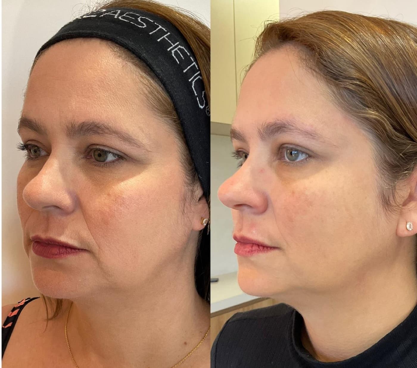Resultado real de botox full face, antes e depois (1 de 3)