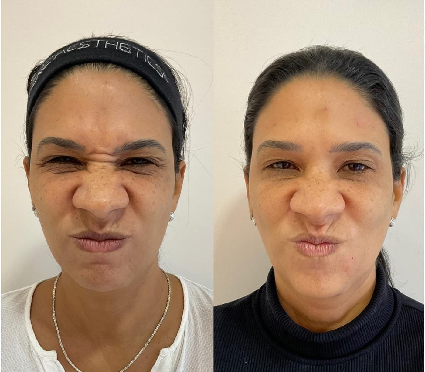 Resultado real de botox full face, antes e depois (2)