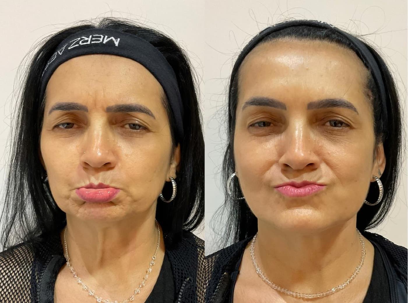 Resultado real de botox full face, antes e depois (3)
