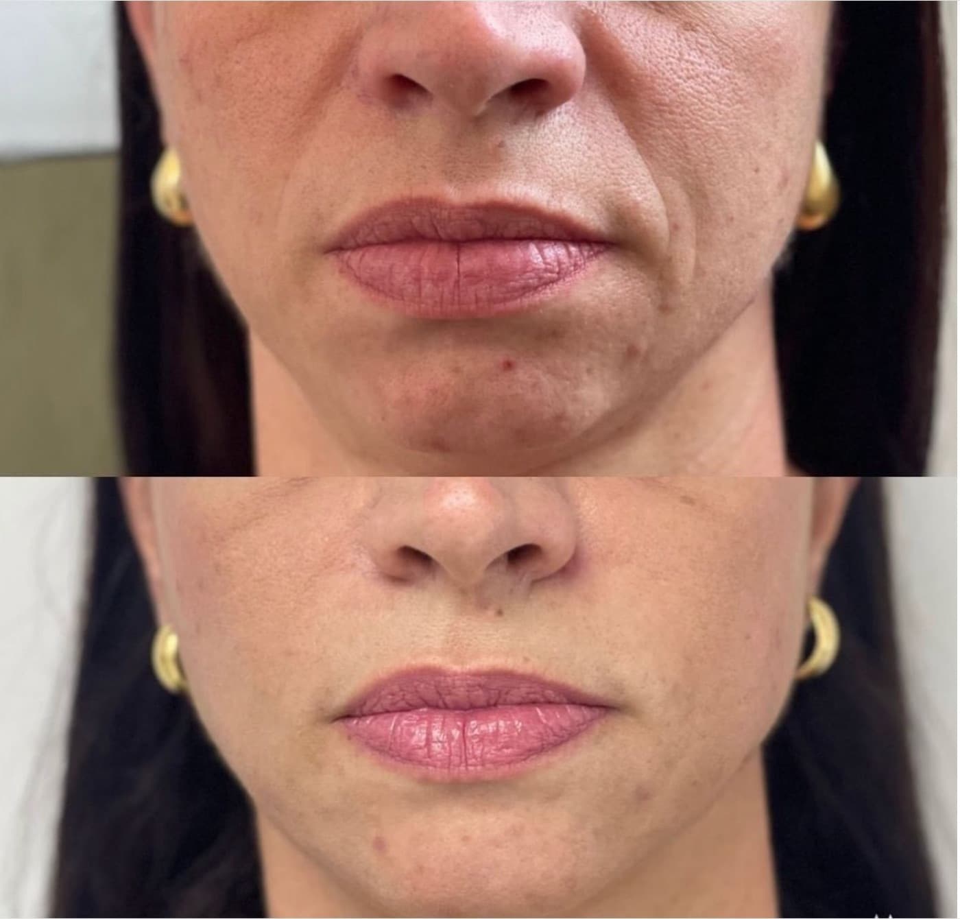 Resultado real de preenchimento do bigode chinês, antes e depois (1 de 2)