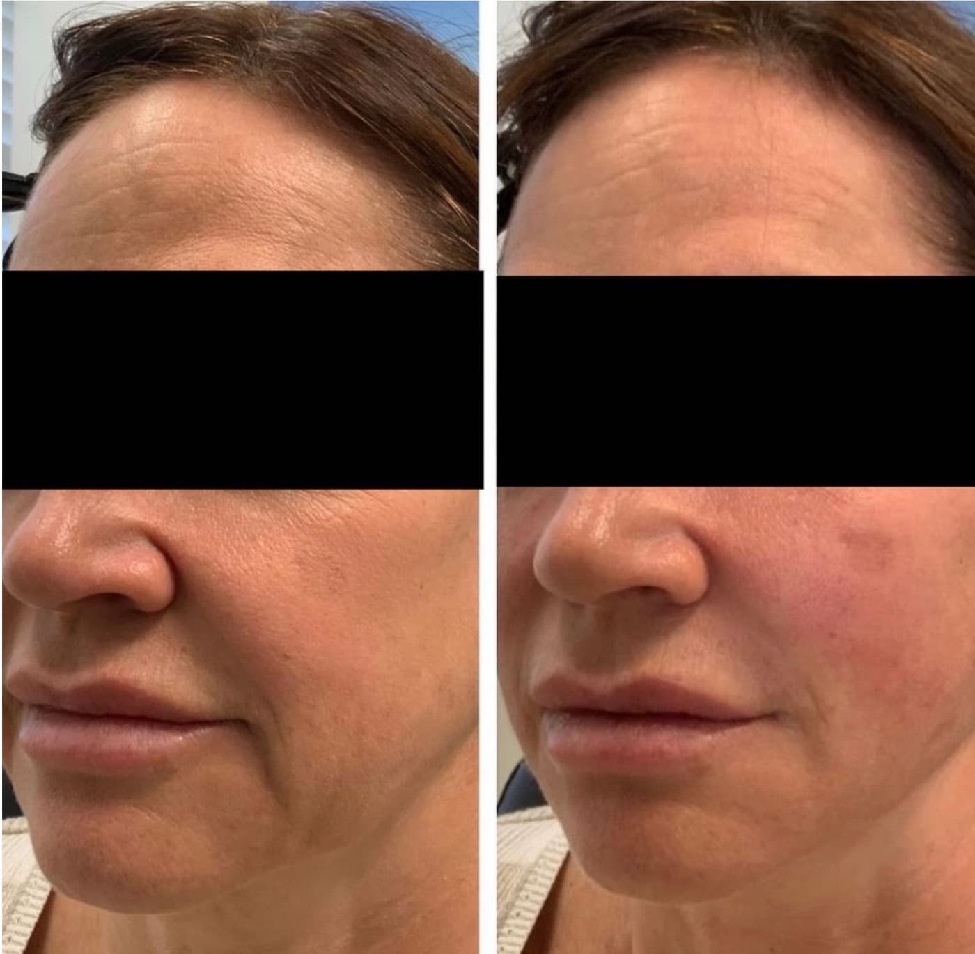 Resultado real de preenchimento do bigode chinês, antes e depois (2)
