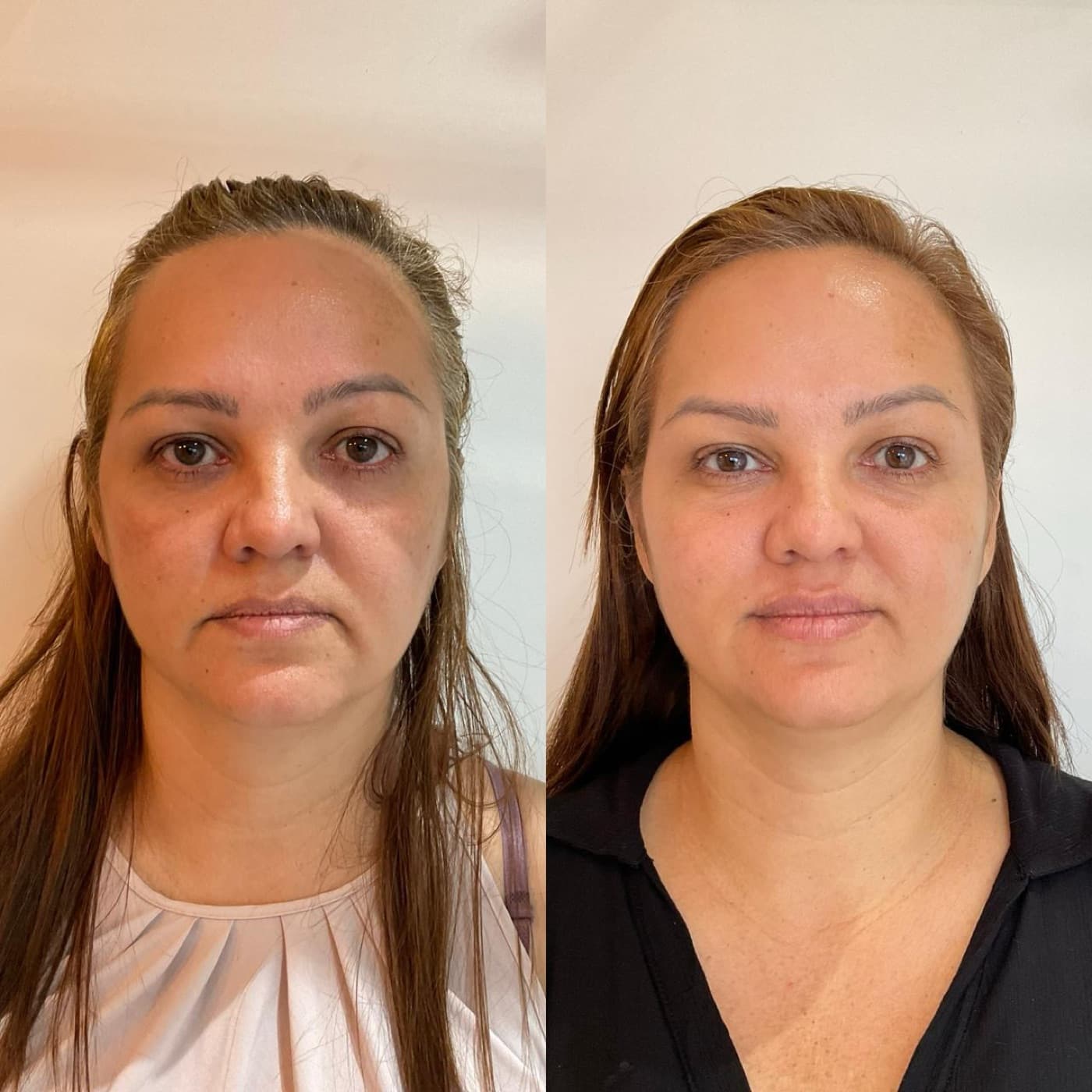 Resultado real de preenchimento labial, antes e depois (1 de 3)