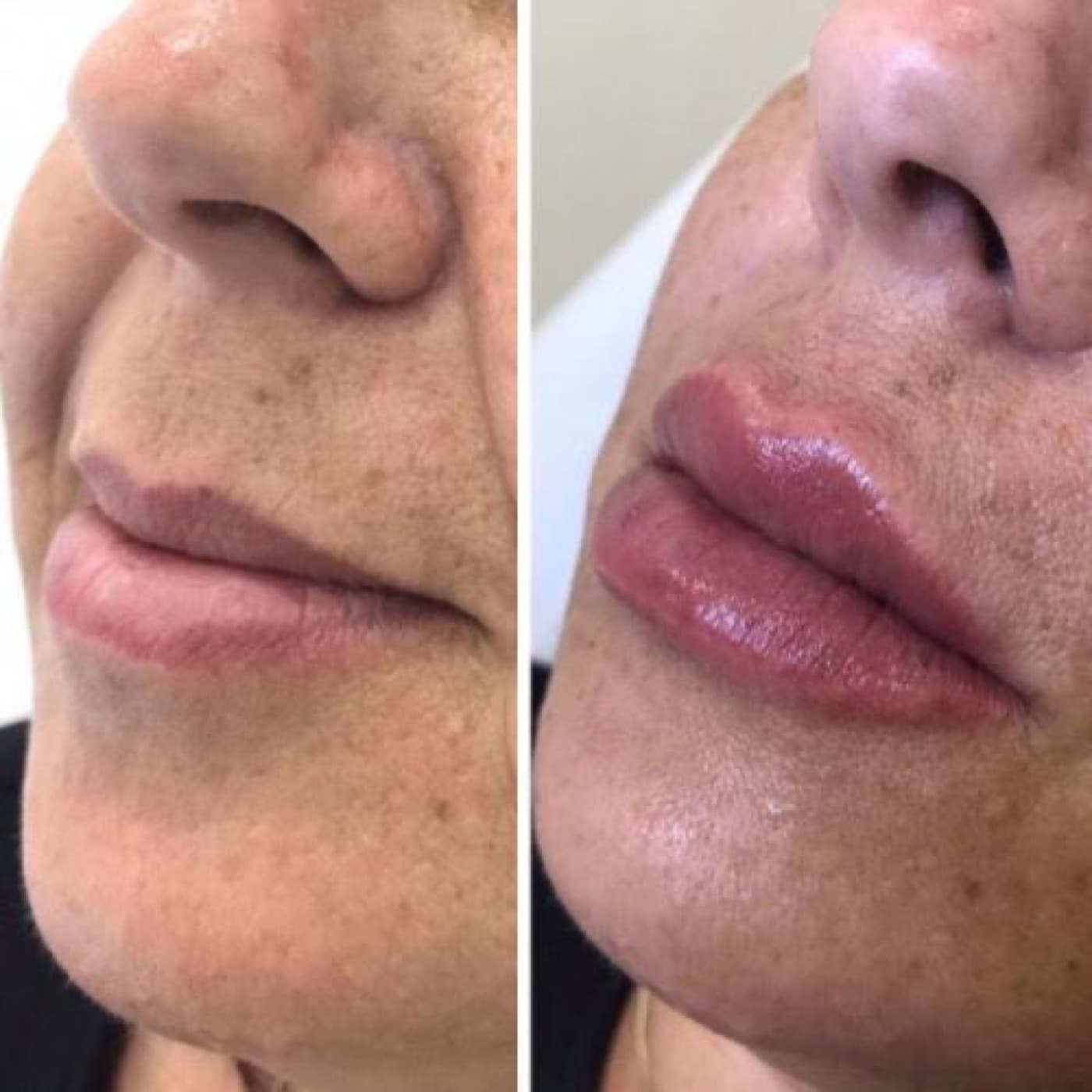 Resultado real de preenchimento labial, antes e depois (2)