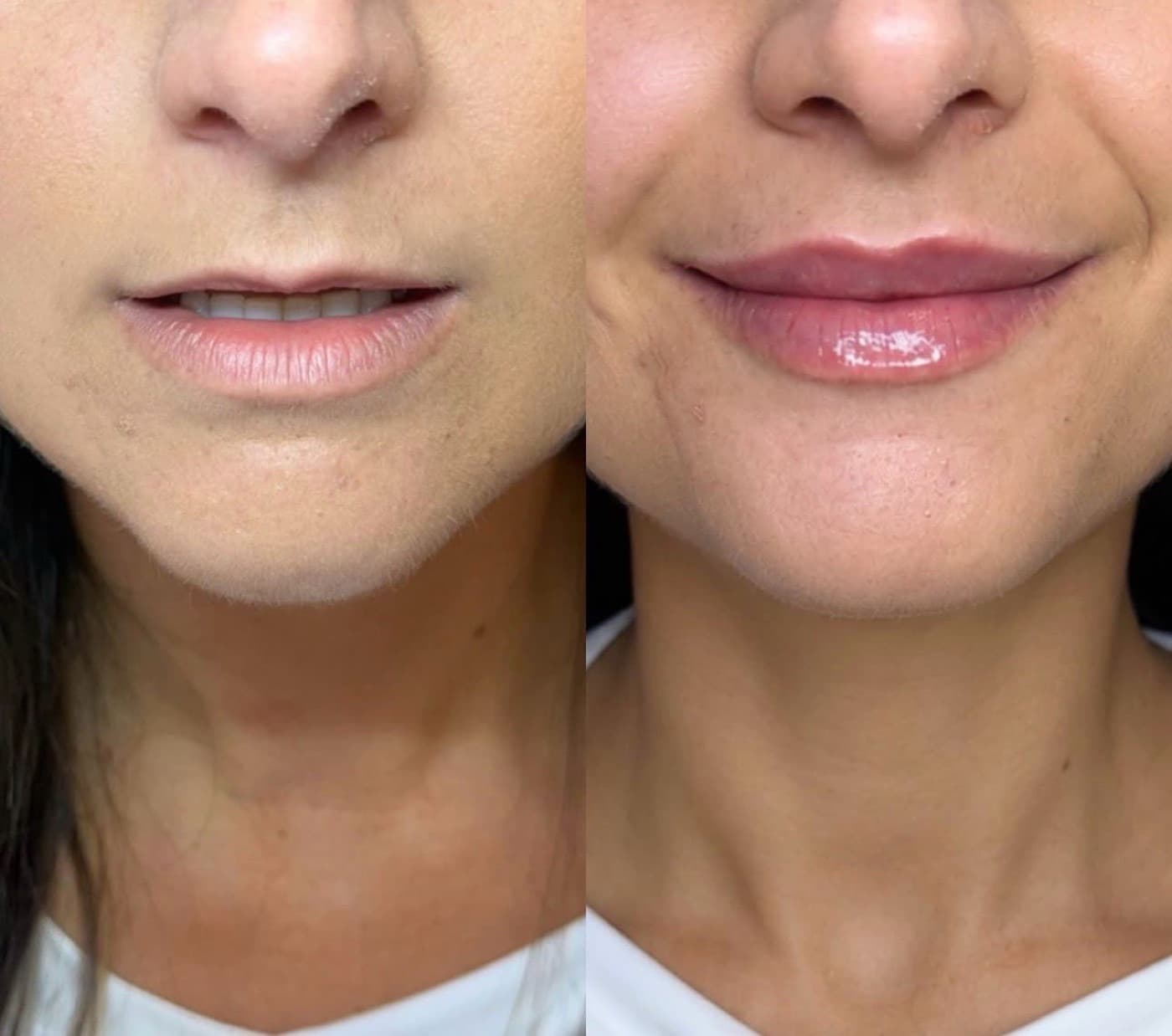 Resultado real de preenchimento labial, antes e depois (3)