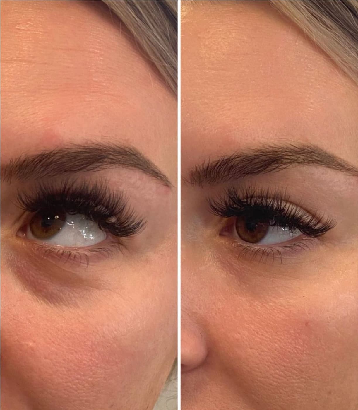 Resultado real de preenchimento de olheiras, antes e depois (1 de 3)