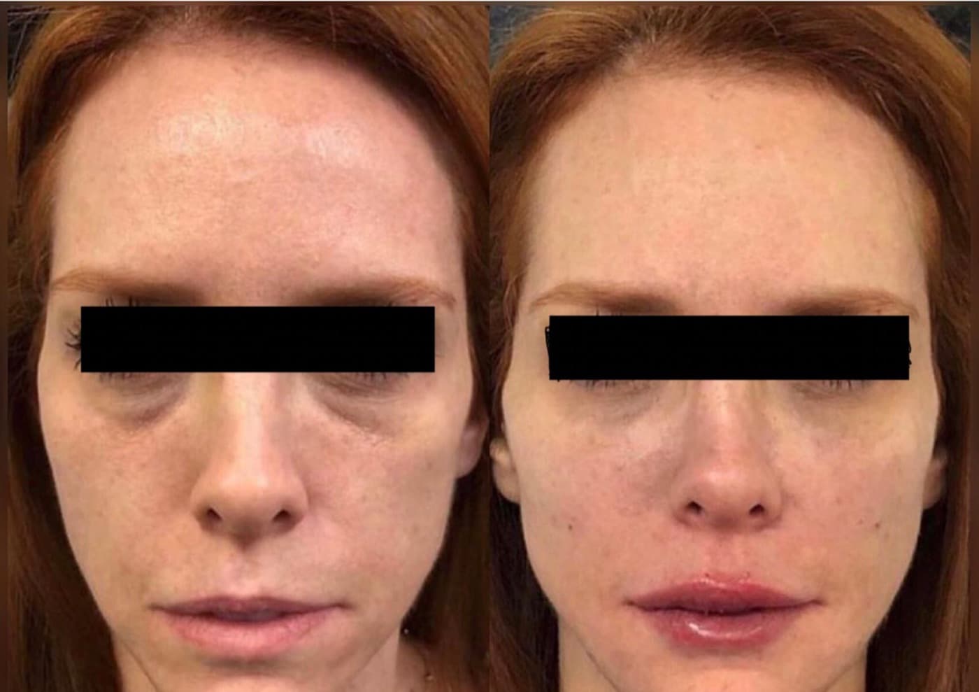 Resultado real de preenchimento de olheiras, antes e depois (2)