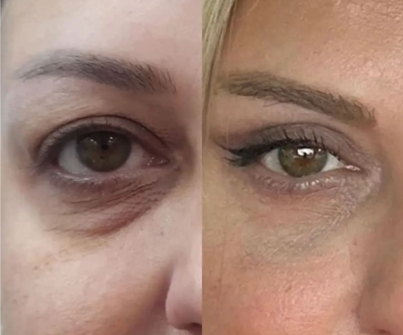 Resultado real de preenchimento de olheiras, antes e depois (3)