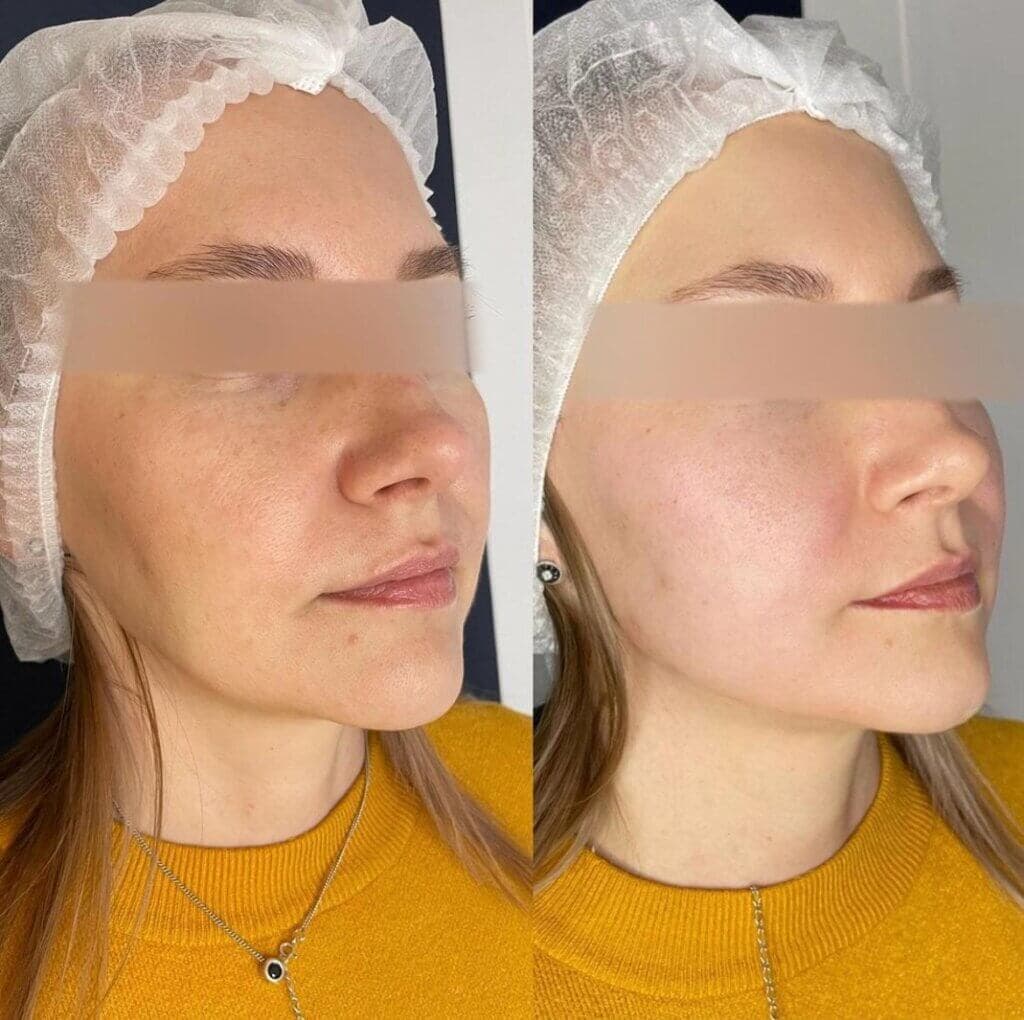 Resultado real de pdrn — antes e depois