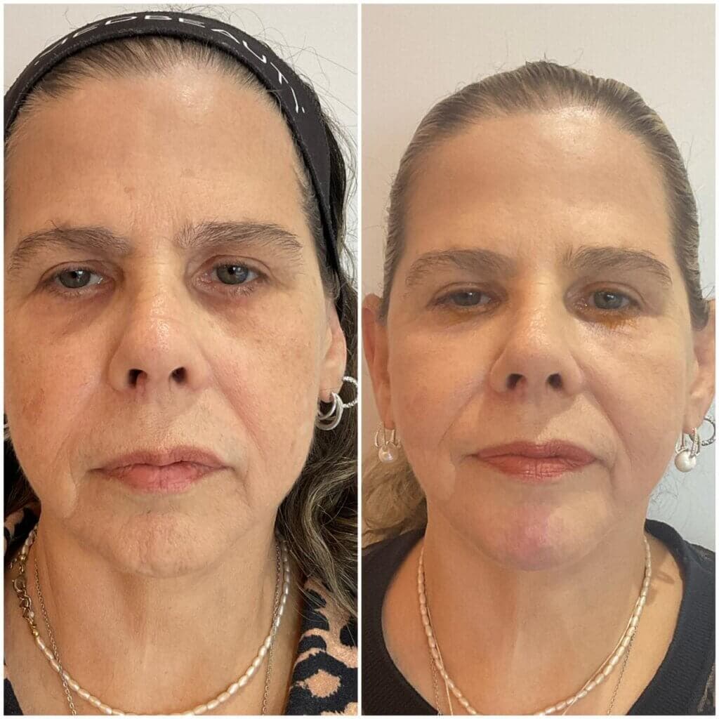 Resultado real de botox full face — antes e depois
