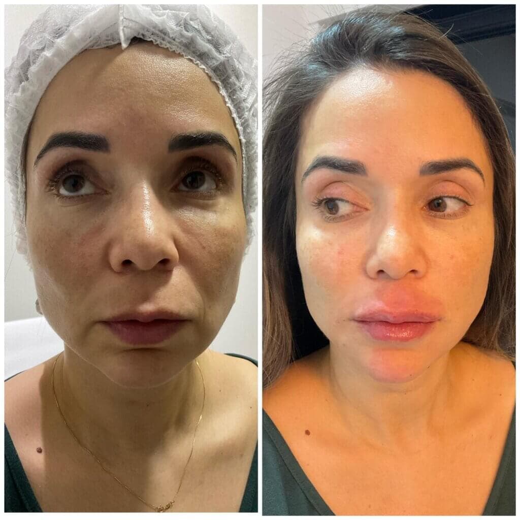 Resultado real de preenchimento do bigode chinês — antes e depois