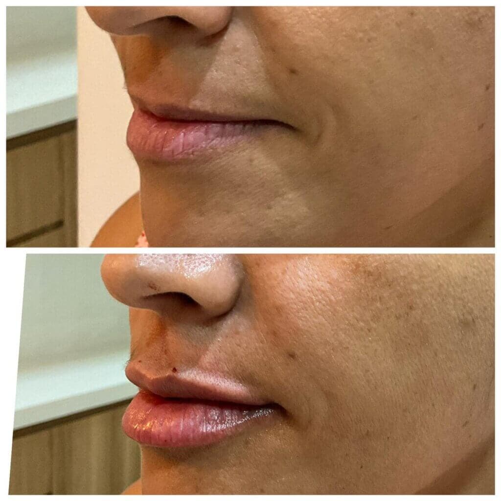 Resultado real de harmonização facial — antes e depois
