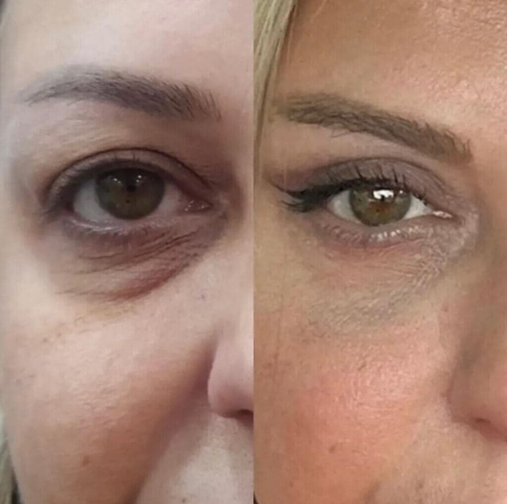 Resultado real de preenchimento de queixo e mandíbula — antes e depois